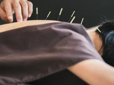 Akupunktura és a migrén természetes kezelése – Akupunkturbehandlungen usw