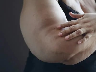 Anzeichen Lipödem: Wie Bewegung und Ernährung helfen können