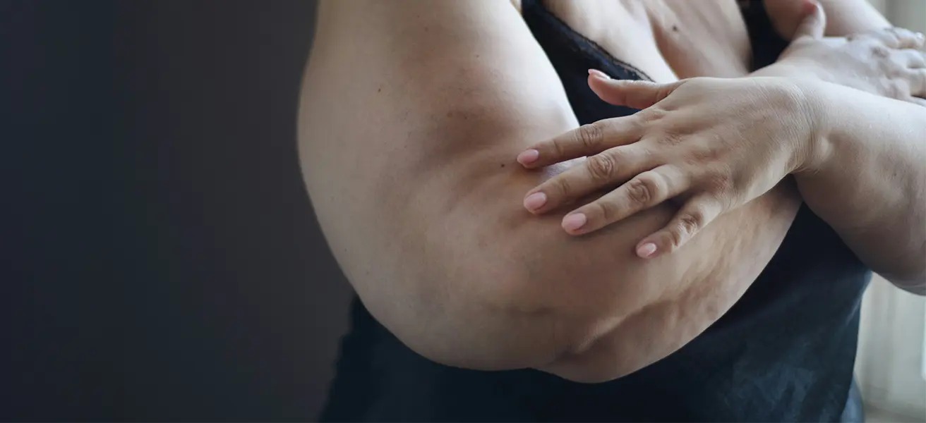 Anzeichen Lipödem: Wie Bewegung und Ernährung helfen können