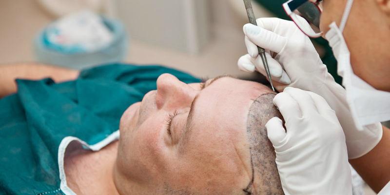Haarausfall Nürnberg: Lippenunterspritzung und mehr bei MY AESTHETICS für ein jugendliches Aussehen